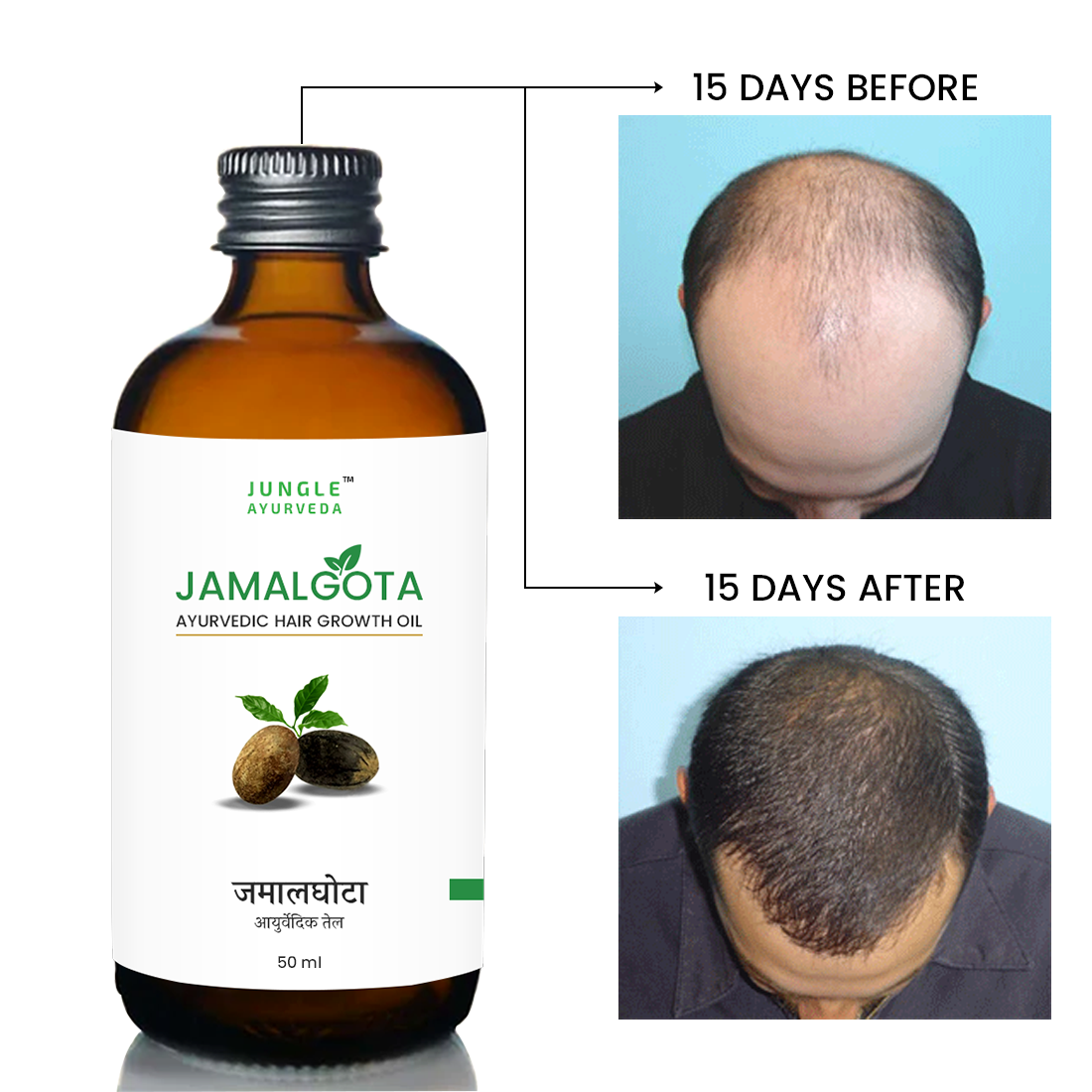 Jamalgota Oil for Hair Regrowth and Alopecia for Men and Women